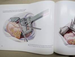 Atlas chirurgischer operationen mit anwendung von nähapparaten / -neuvostoliittolaisten kirurgisten välineiden kuvitettu luettelo - käyttöopas havaintokuvineen